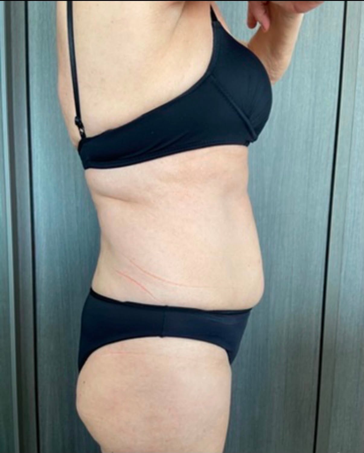 Ozilia Menezes depois do My Lipo