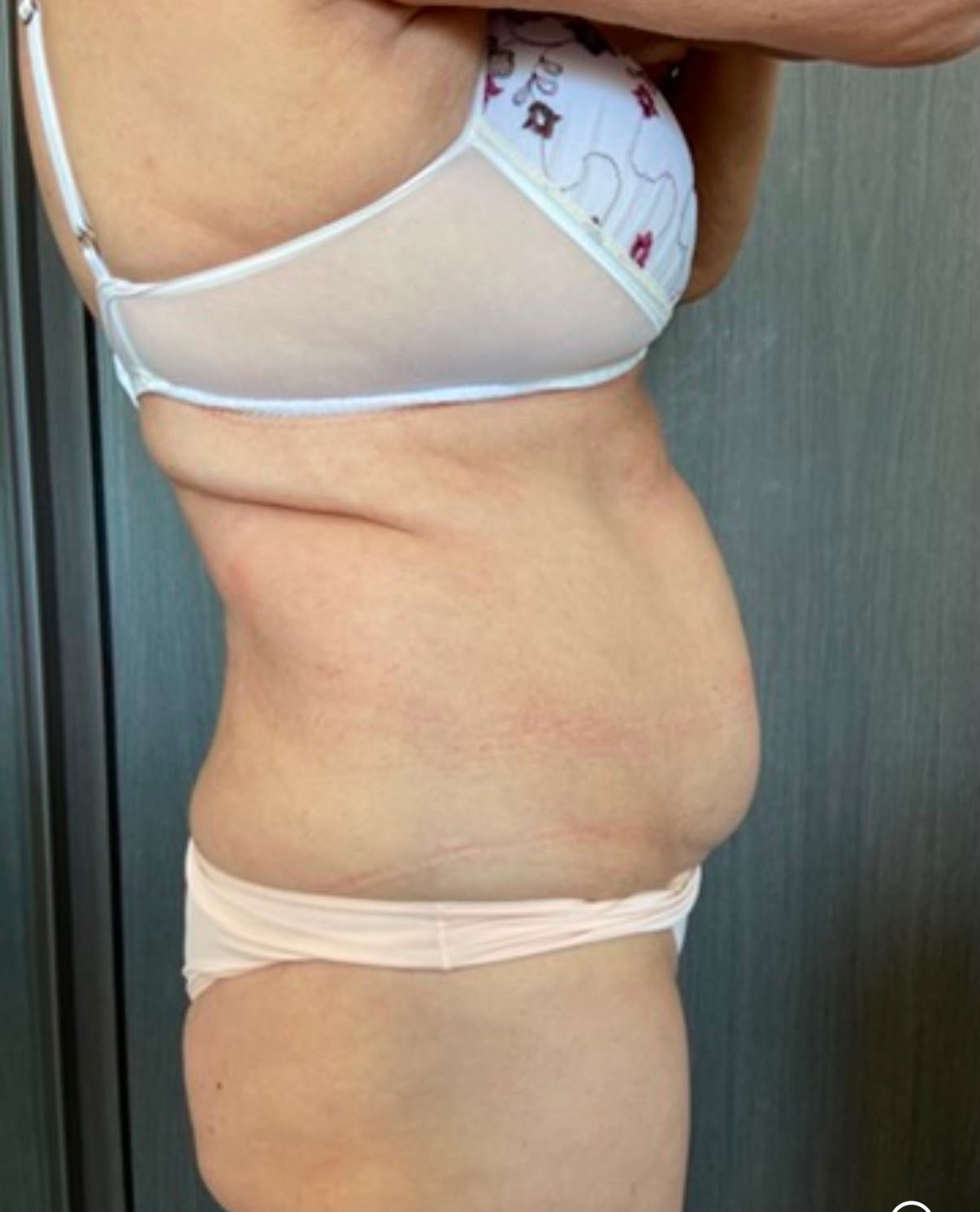 Ozilia Menezes antes do My Lipo